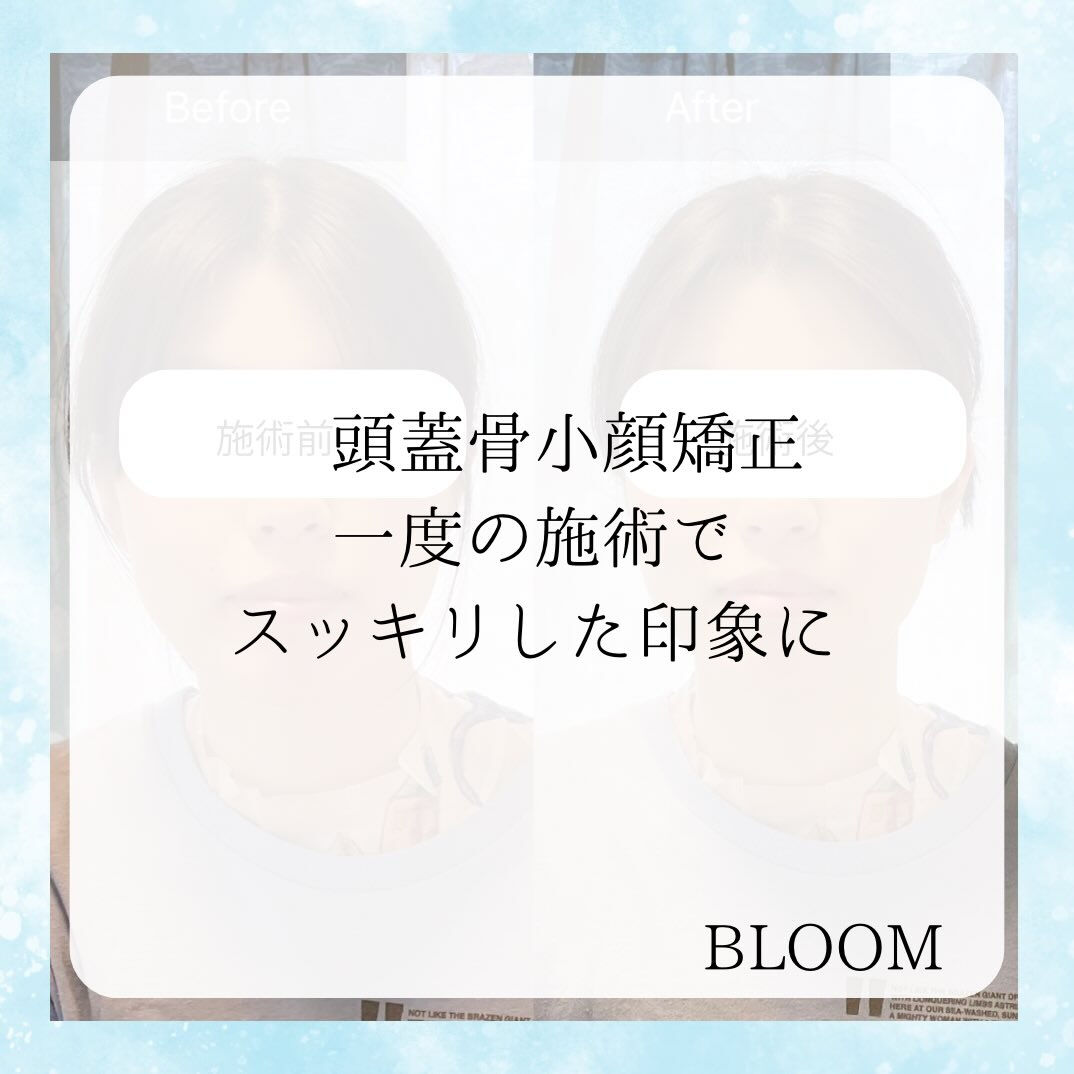 ✨頭蓋骨から整える小顔矯正✨