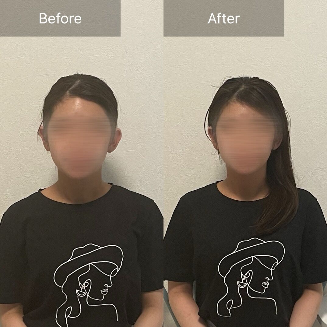 写真でわかる！骨格小顔矯正ビフォーアフター